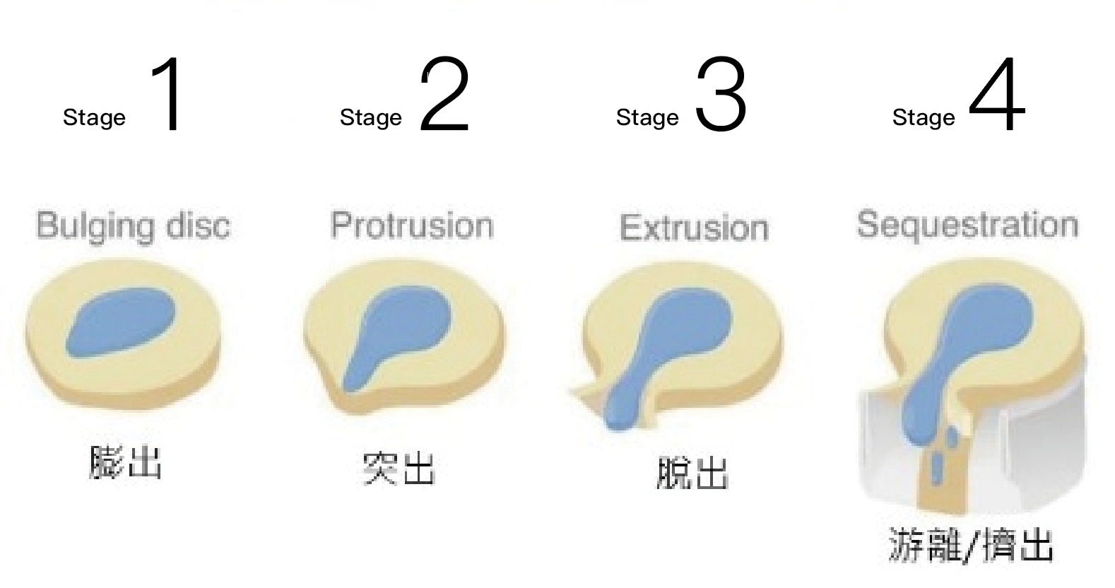 椎間盤突出,椎間盤突出台中